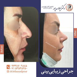 جراحی بینی - دکتر اسدپور