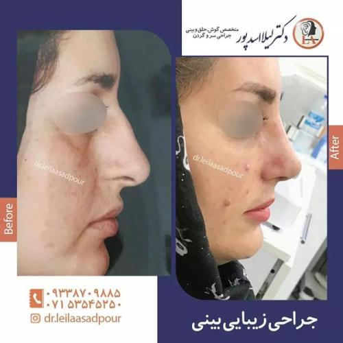 جراحی-بینی-در-داراب-12