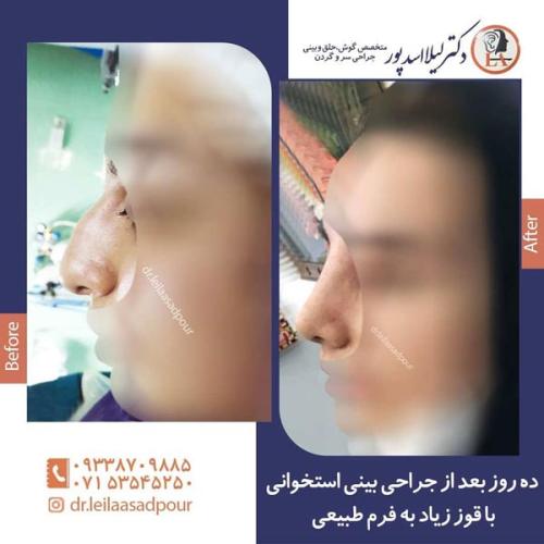 جراحی-بینی-در-داراب-55
